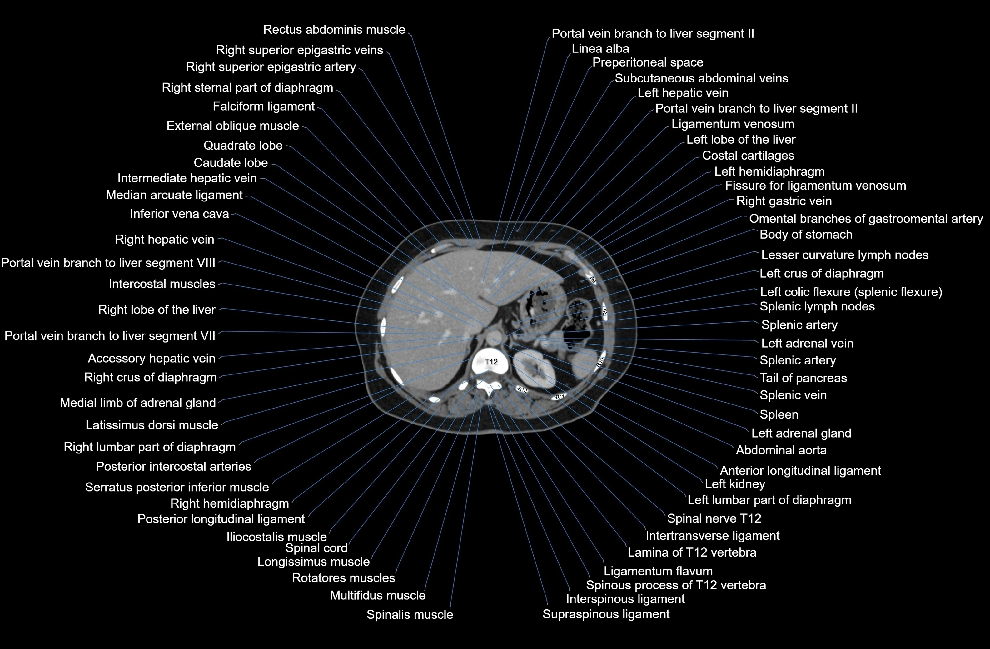 CT Abdomen axial cross sectional anatomy labelled radiology image-00020.webp